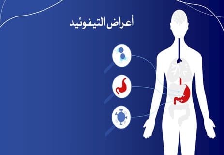 التيفوئيد يبدأ بهدوء… ثم يتحول إلى خطر 10 مرض التيفوئيد (الحمى التيفية)