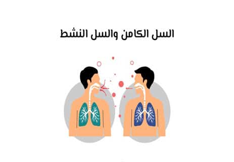 مرض السل (Tuberculosis): دليل شامل للأعراض والعلاج والوقاية 11 هل السل معدي