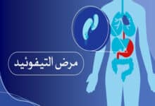 مرض التيفوئيد (الحمى التيفية)