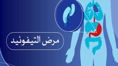 مرض التيفوئيد (الحمى التيفية)
